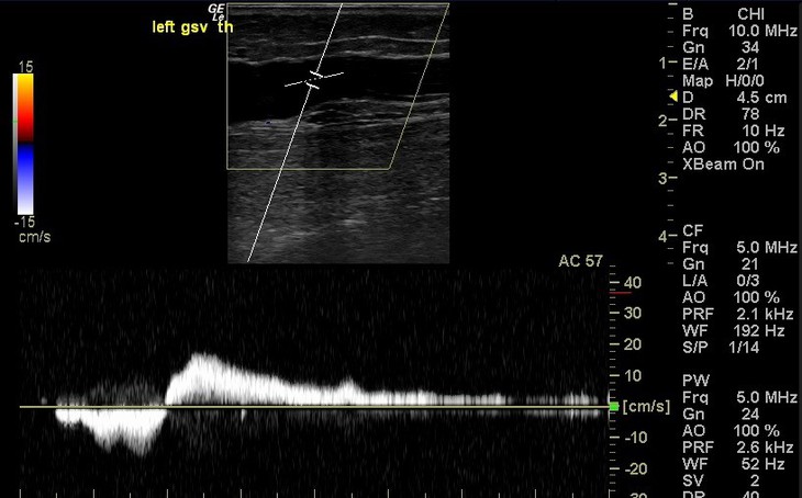 Dòng chảy ngược trên doppler xung